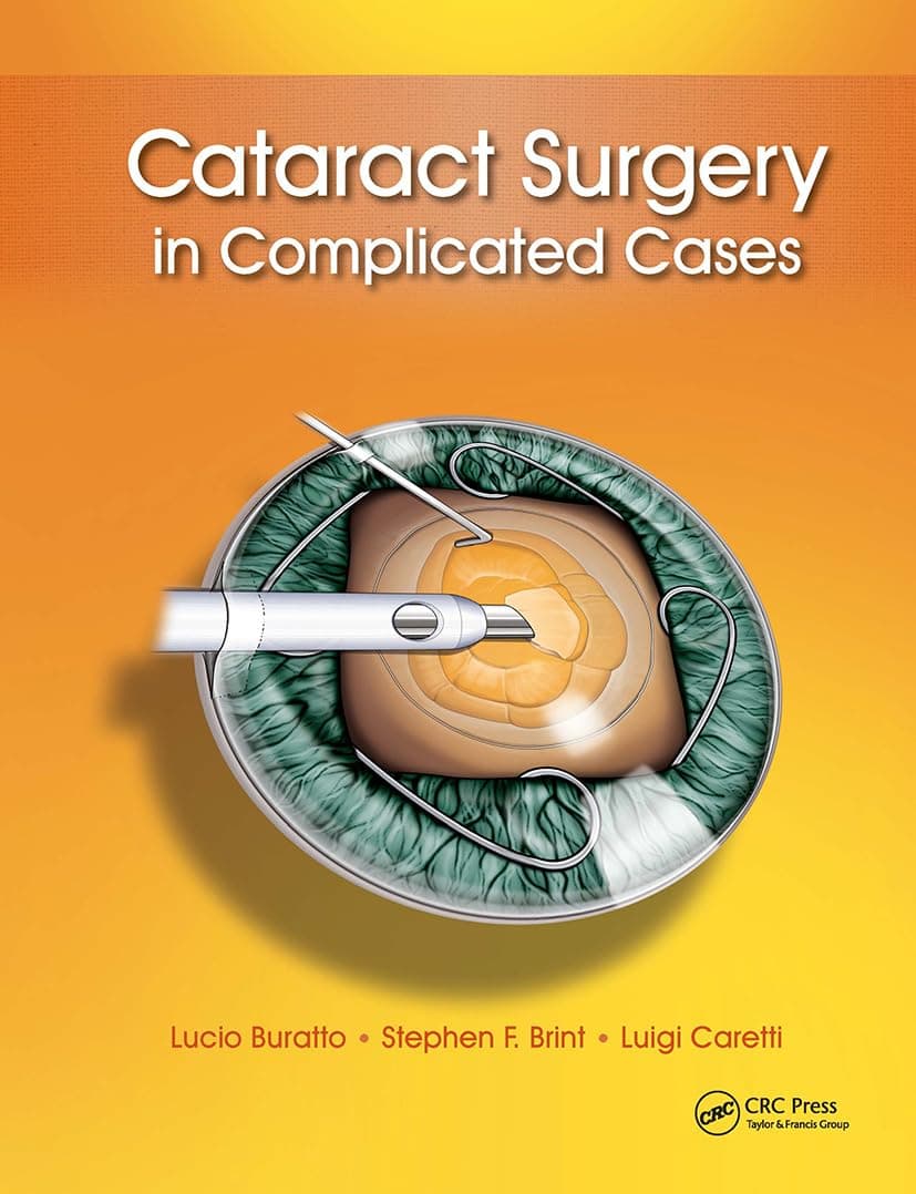 Cataract Surgery in Complicated Cases 1st Edition