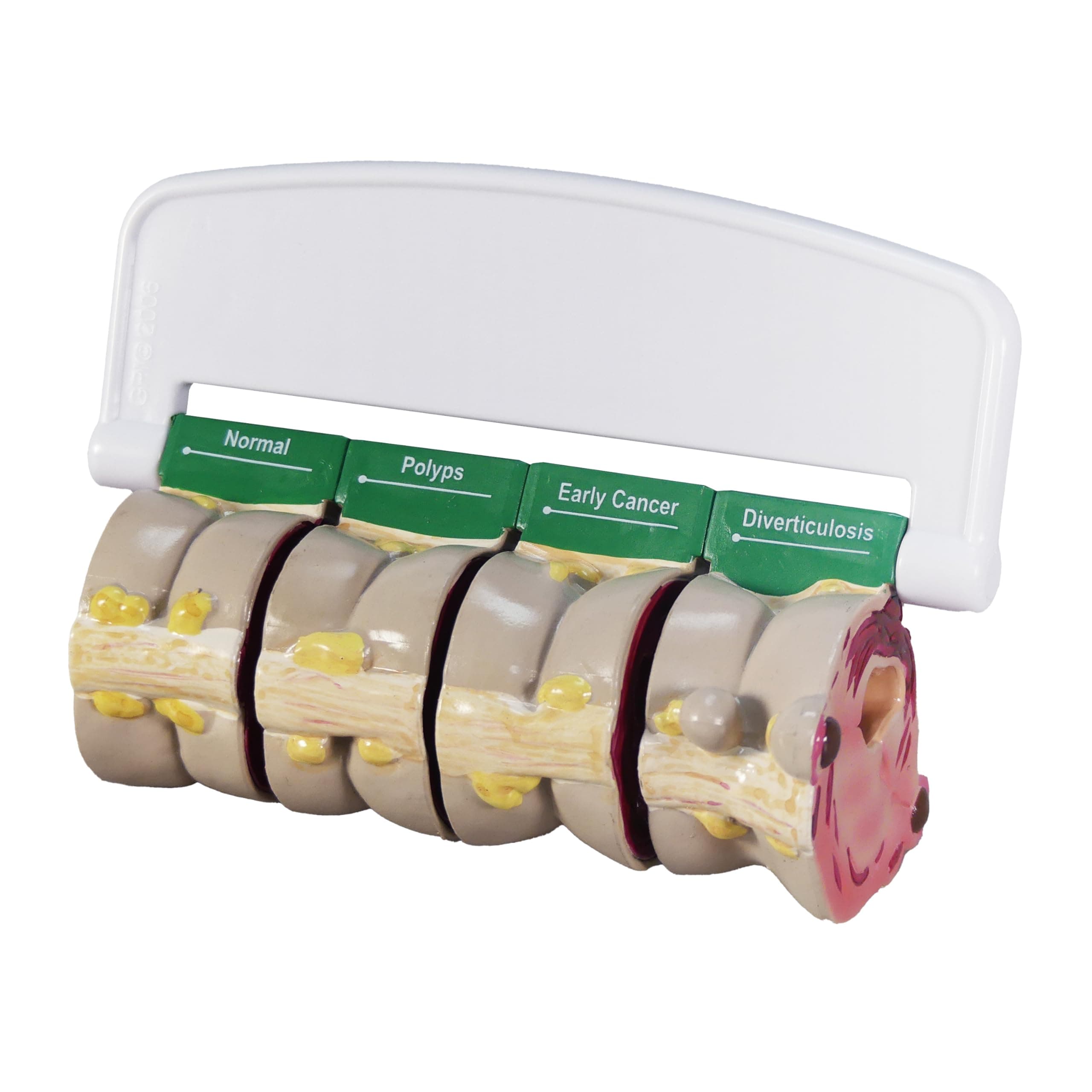GPI Anatomicals Colon Model 4-piece Set with Pathologies